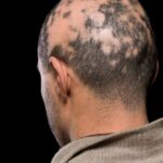 Alopecia | Prasadini Hospital | Puttur